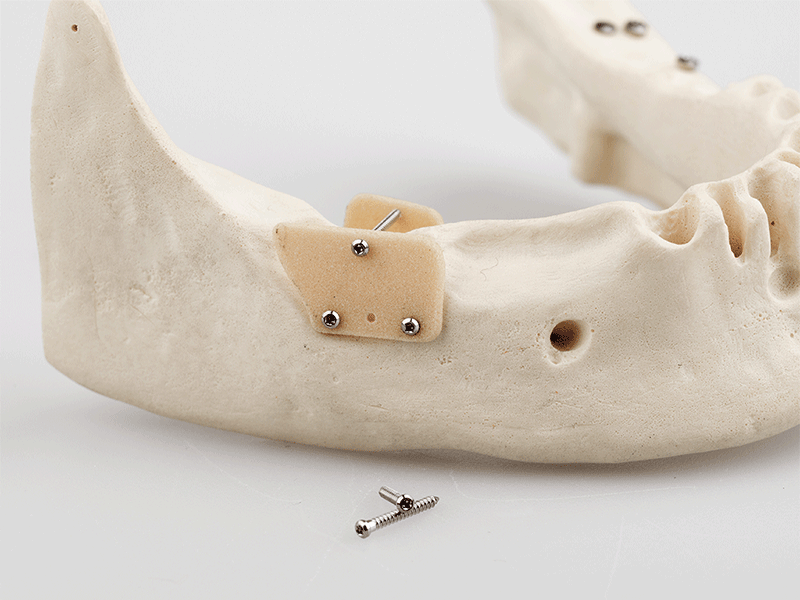 Edelstahl Mikroschrauben dental für Schalentechnik